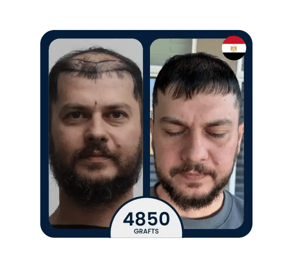 FUE hair transplant before after 4850 grafts