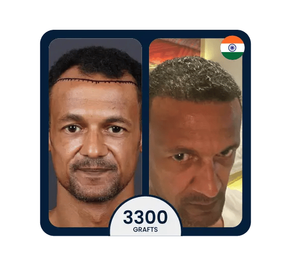 FUE hair transplant before after 3300 grafts