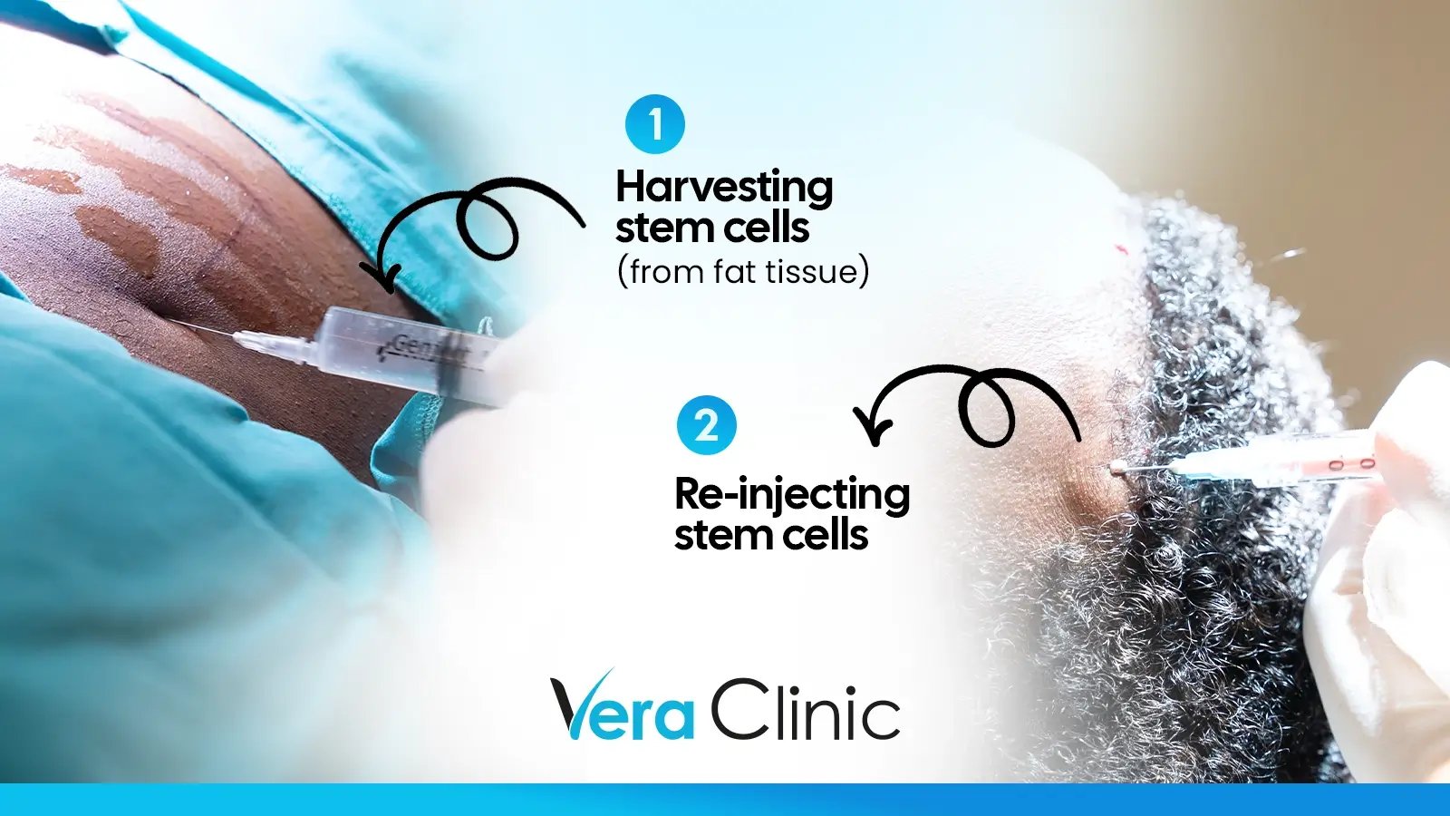 Stem cells stimulates hair growth
