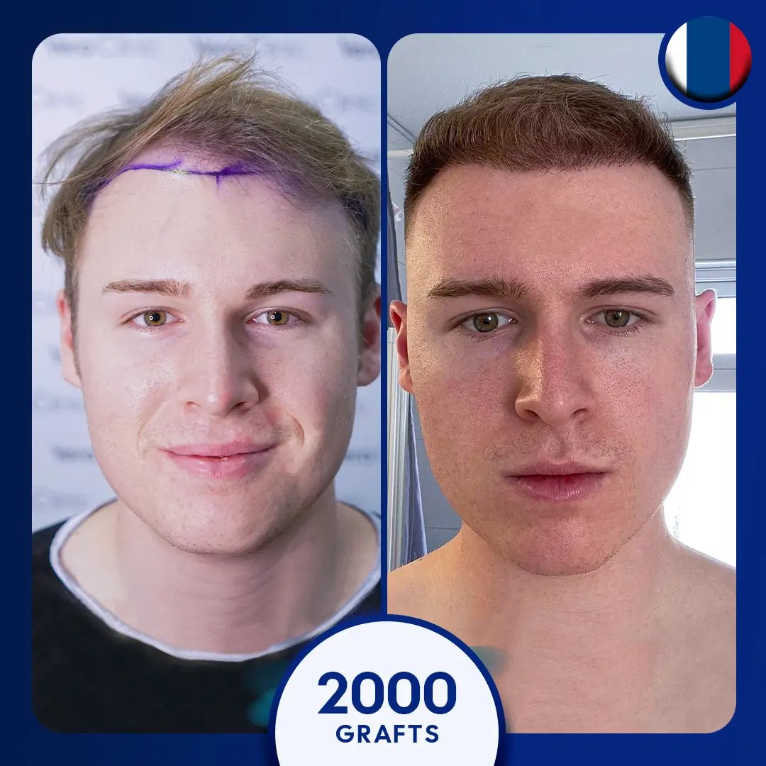 2000 grafts DHI hair transplant male, blond, hairline
