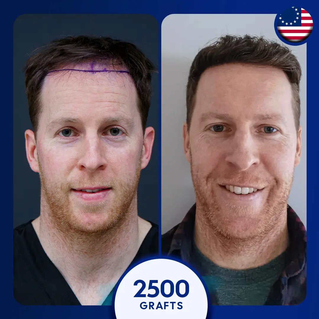 2500 grafts DHI hair transplant male, hairline
