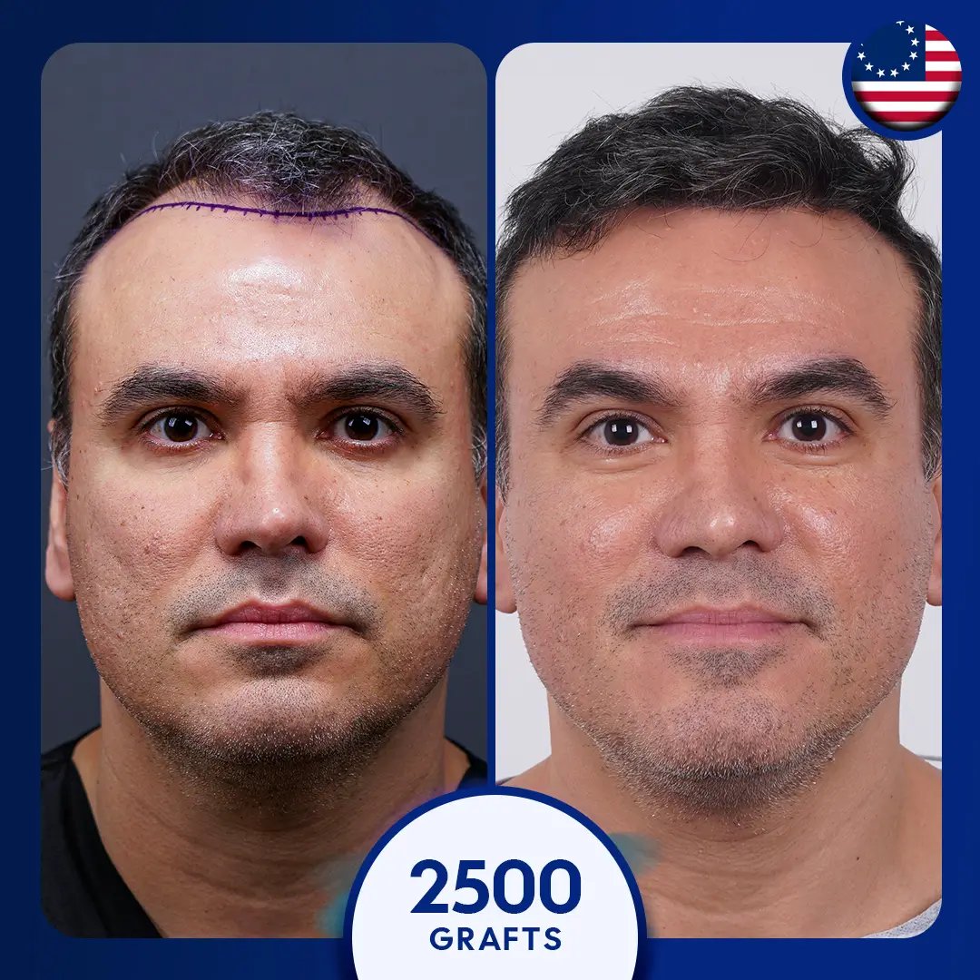 2500 grafts DHI hair transplant male, natural hairline coverage