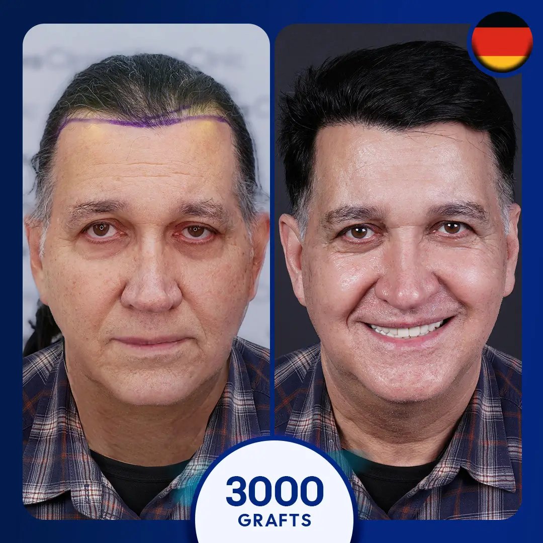 3000 grafts DHI hair transplant full coverage male