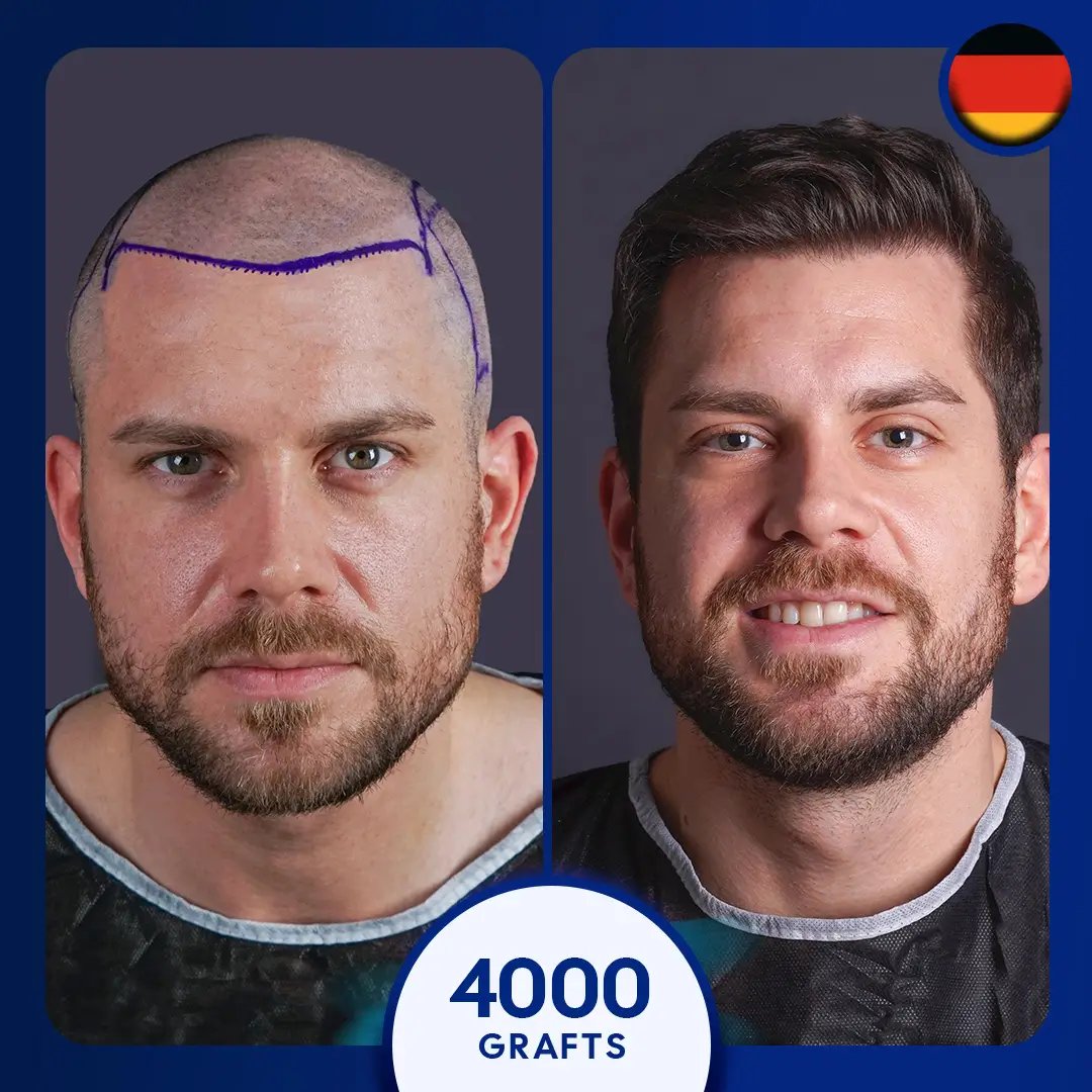 4000 grafts DHI hair transplant full coverage male