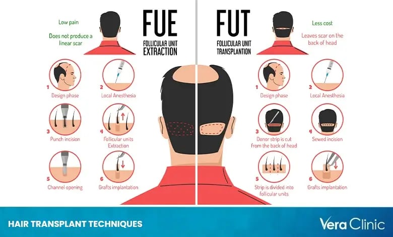 8 Types Of Hair Transplant Techniques Vera Clinic 8 Types Of Hair Transplant Techniques Vera Clinic