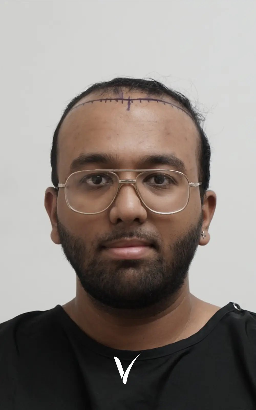4000 Grafts Before Afro Hair Transplant, severe receding hairline