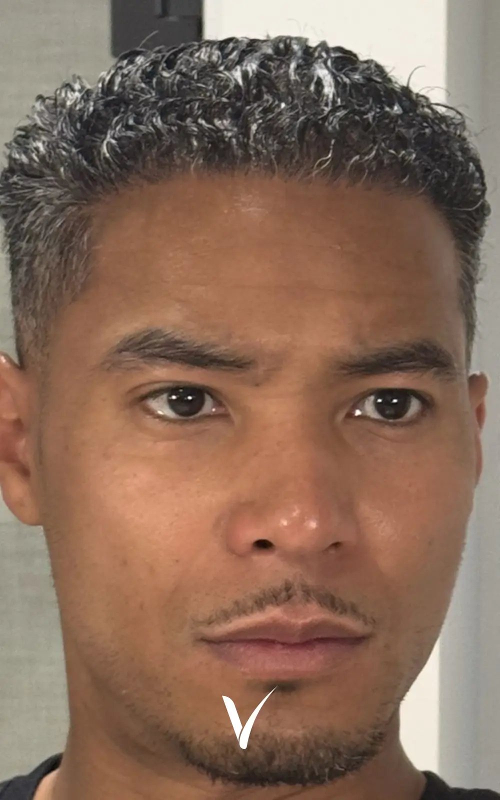 5000 Grafts After Afro Hair Transplant full-coverage for the entire scalp with natural afro-textured hair