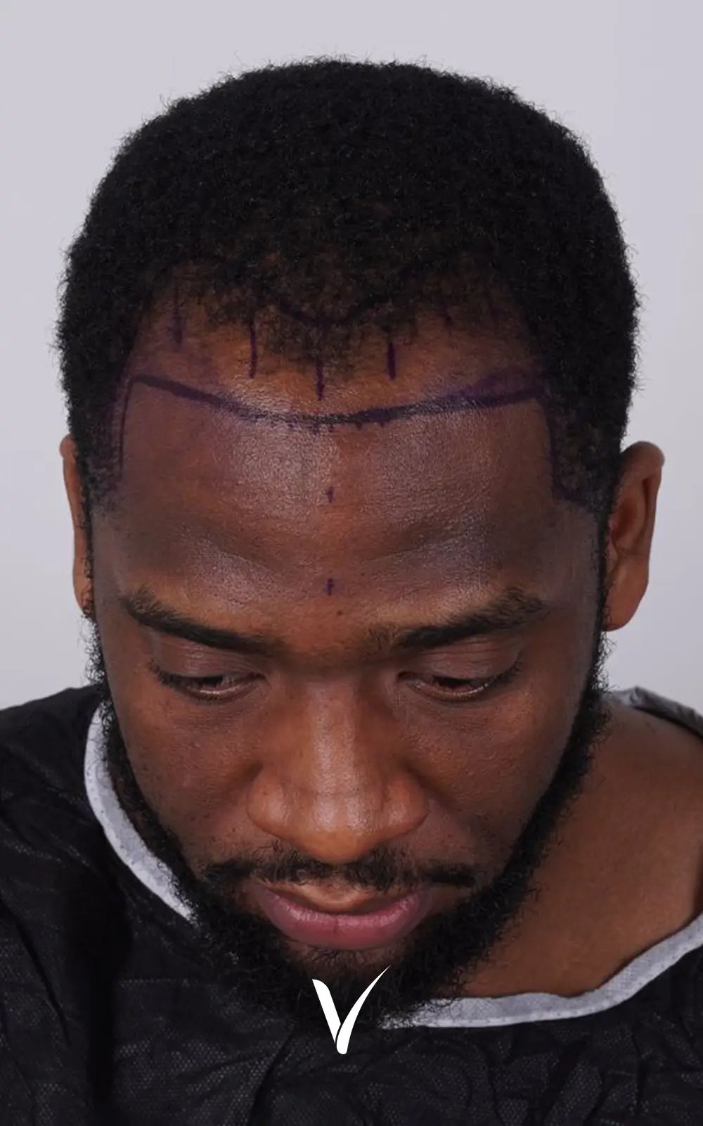 3500 Grafts Before Afro Hair Transplant
