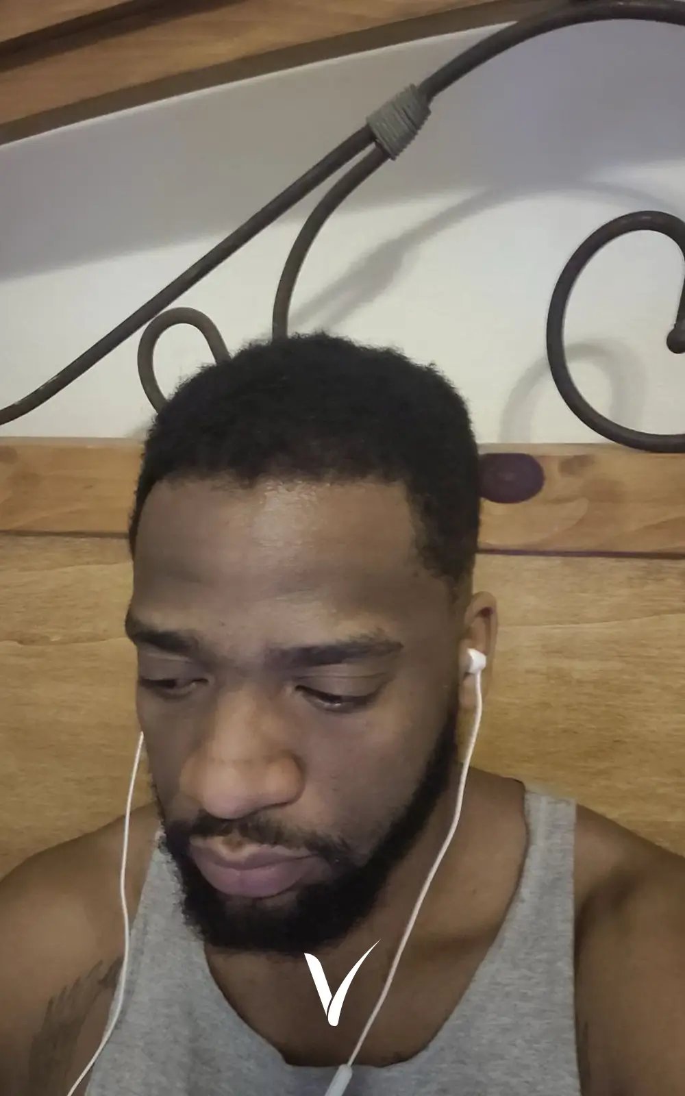 3500 Grafts After Afro Hair Transplant DHI