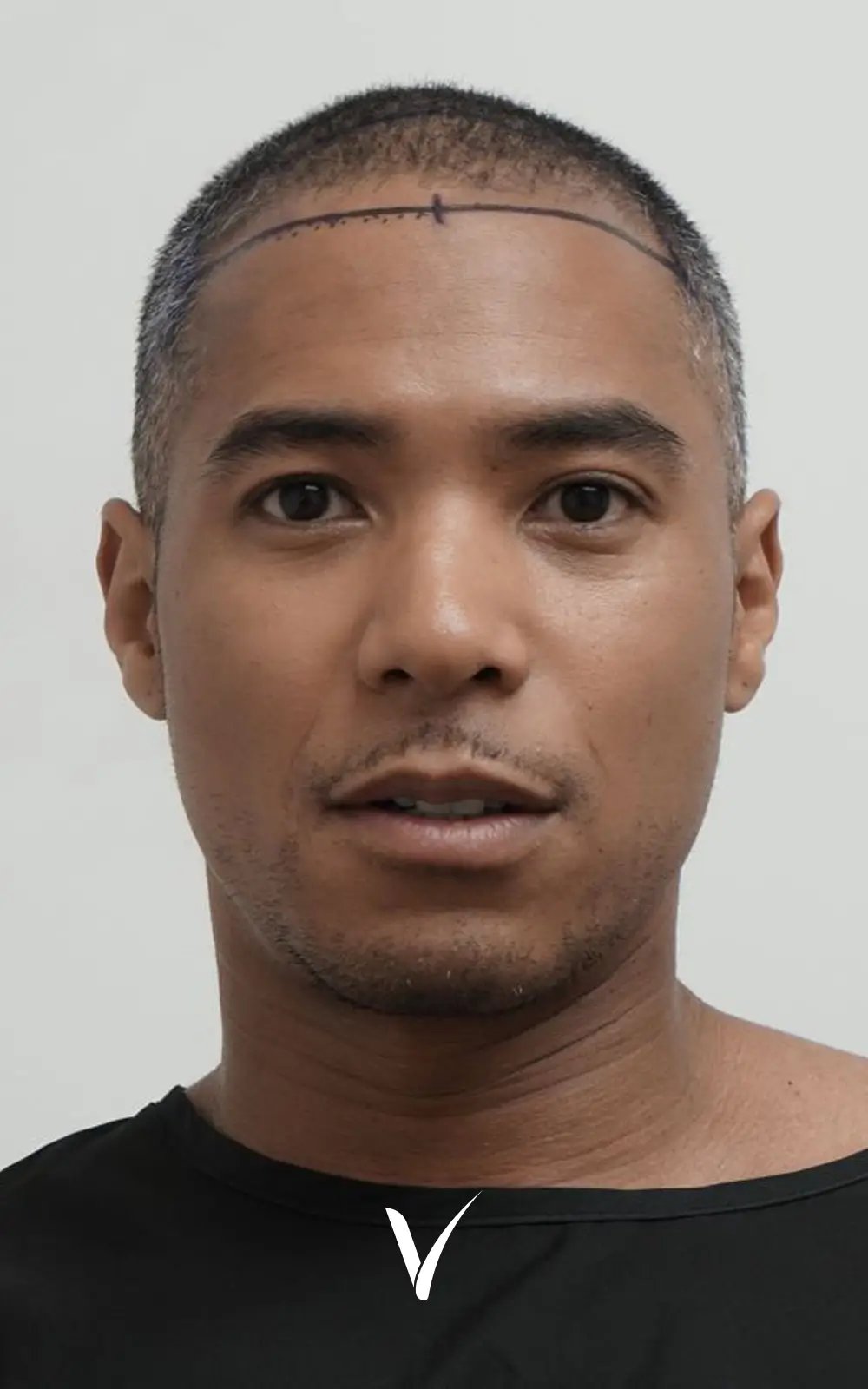 5000 Grafts Before hair transplant, hair loss in frontal, crown, and mid-scalp areas
