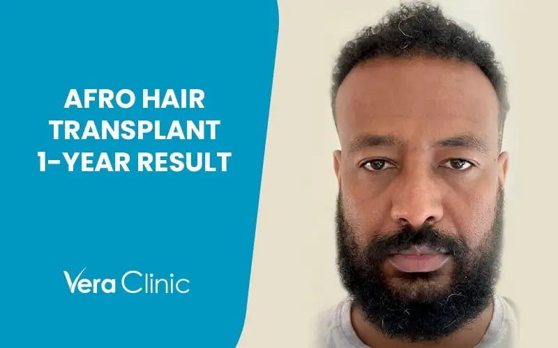 1-Year Afro Hair Transplant Results