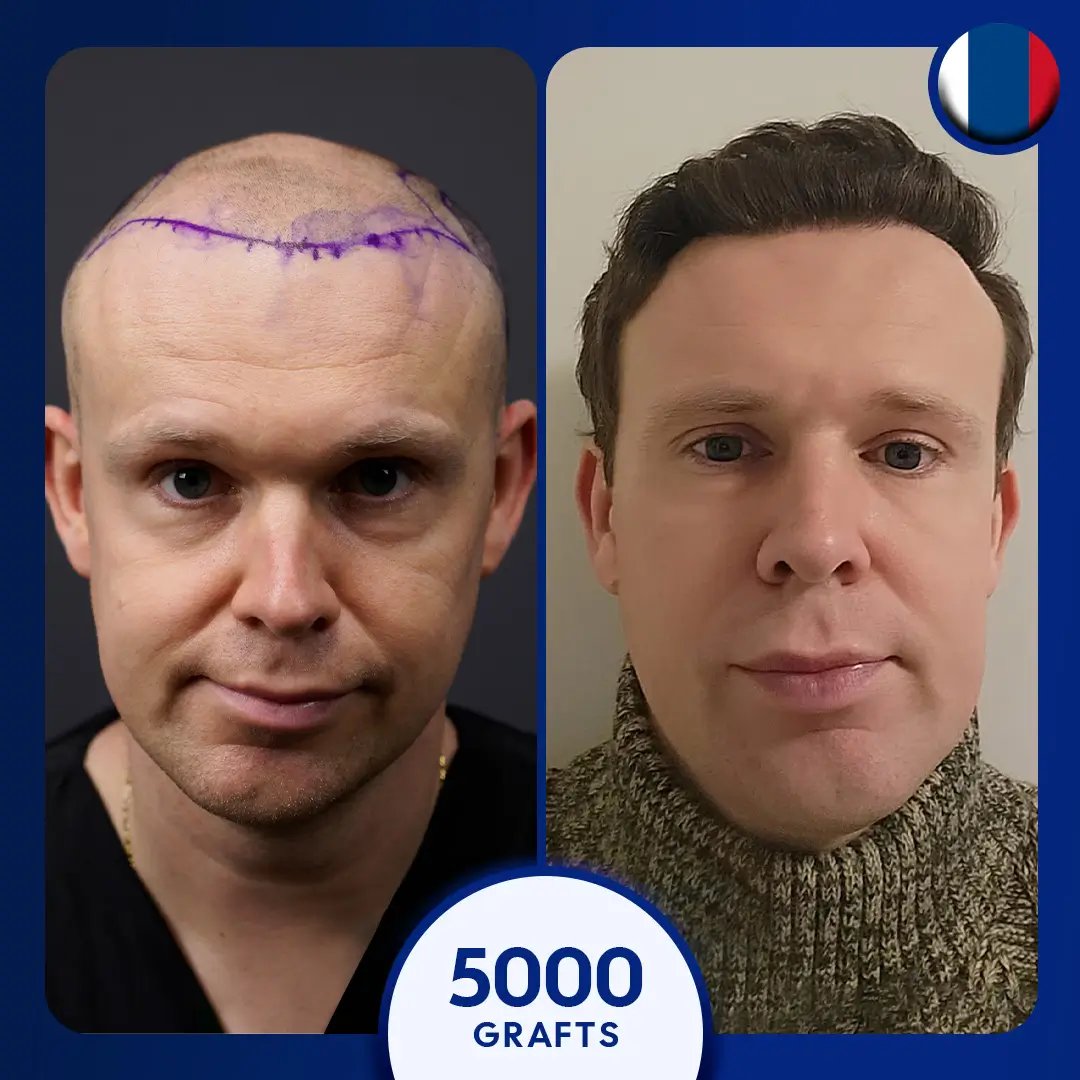5000 grafts fue hair transplant male