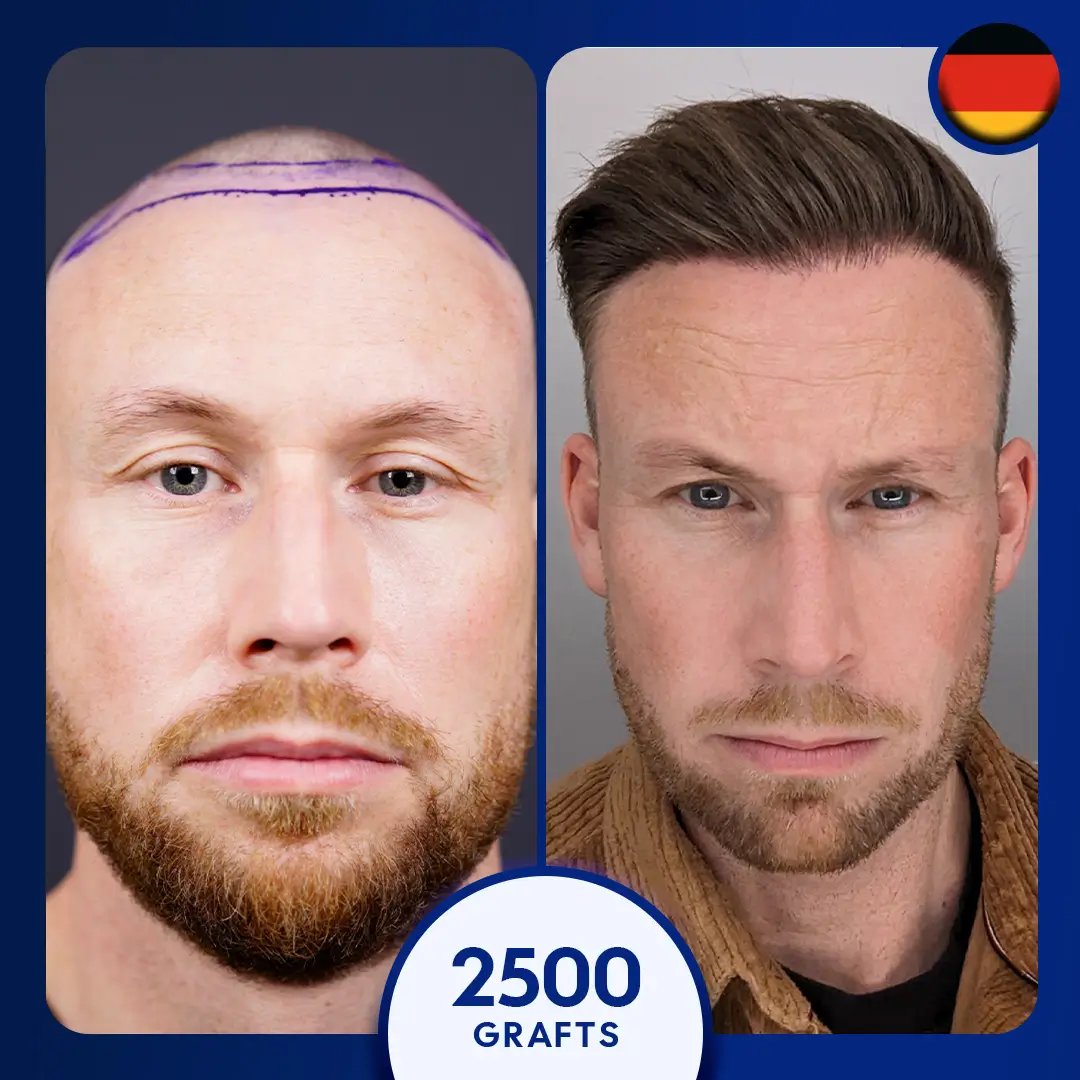 2500 grafts fue hair transplant male hairline