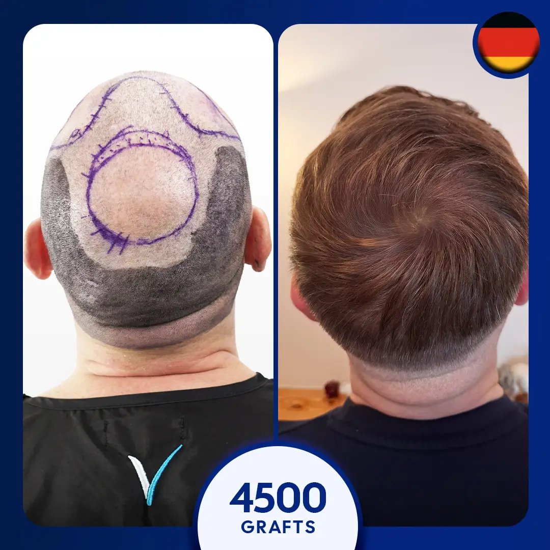 4500 grafts fue hair transplant male hairline and crown