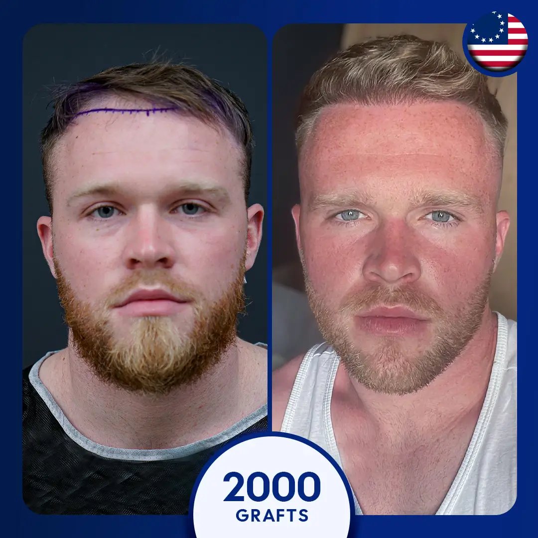 2000 grafts fue hair transplant male hairline