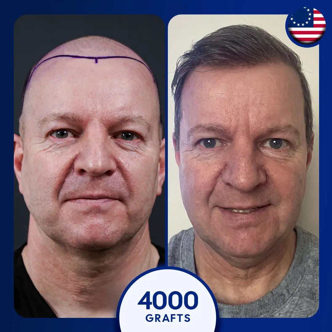 4000 grafts fue hair transplant full coverage