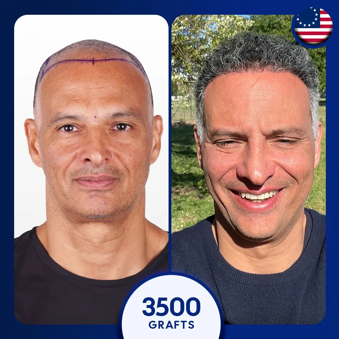 3500 grafts fue hair transplant blach and white hair