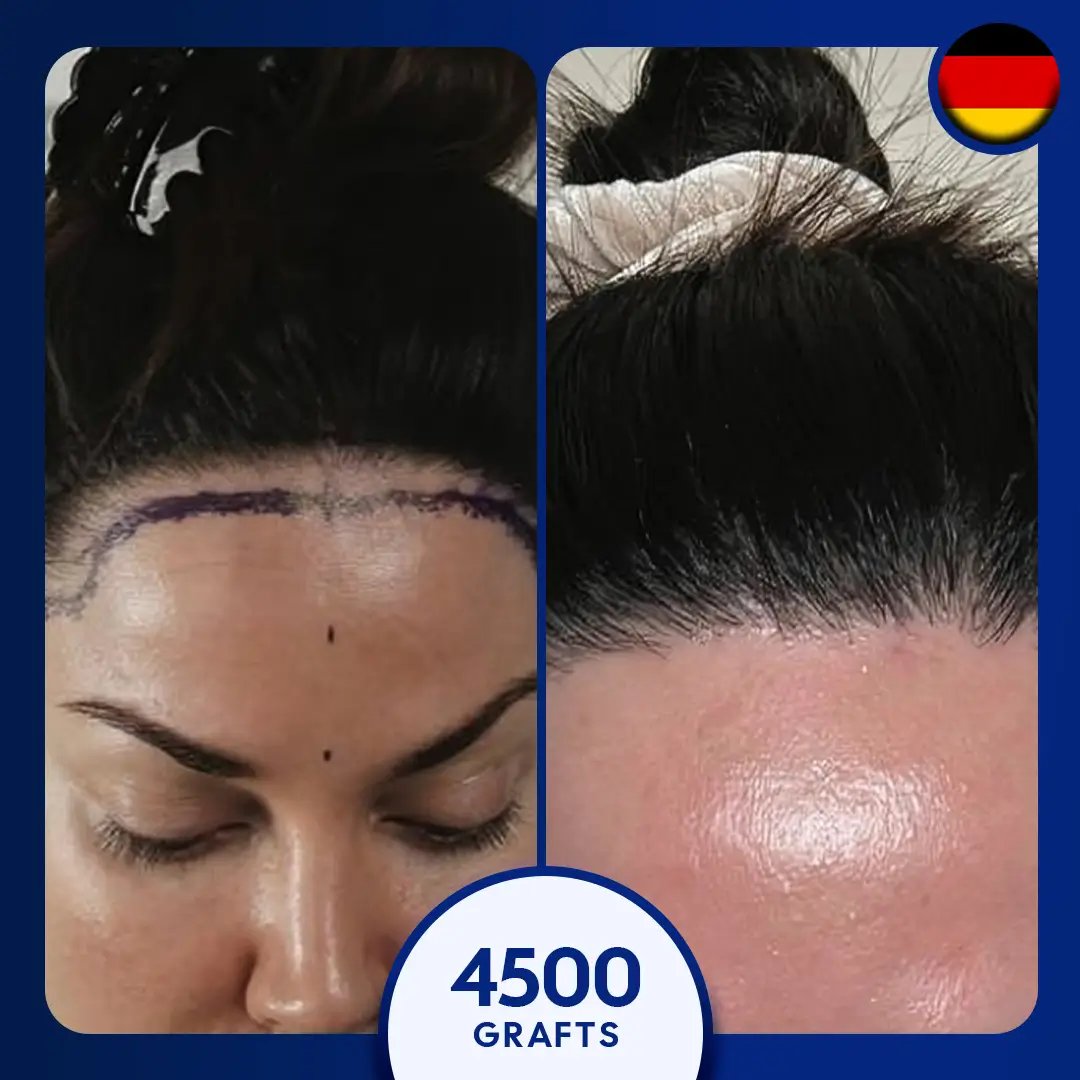 زراعة الشعر 4500 شعرة أنثى 4500