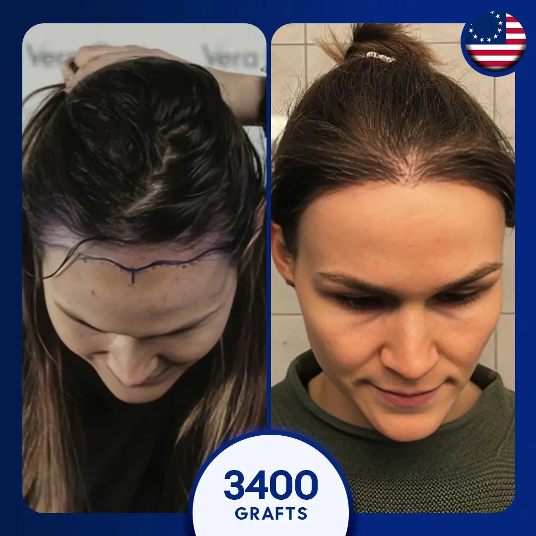 3400 عملية زراعة شعر أنثى، غير محلوق DHI