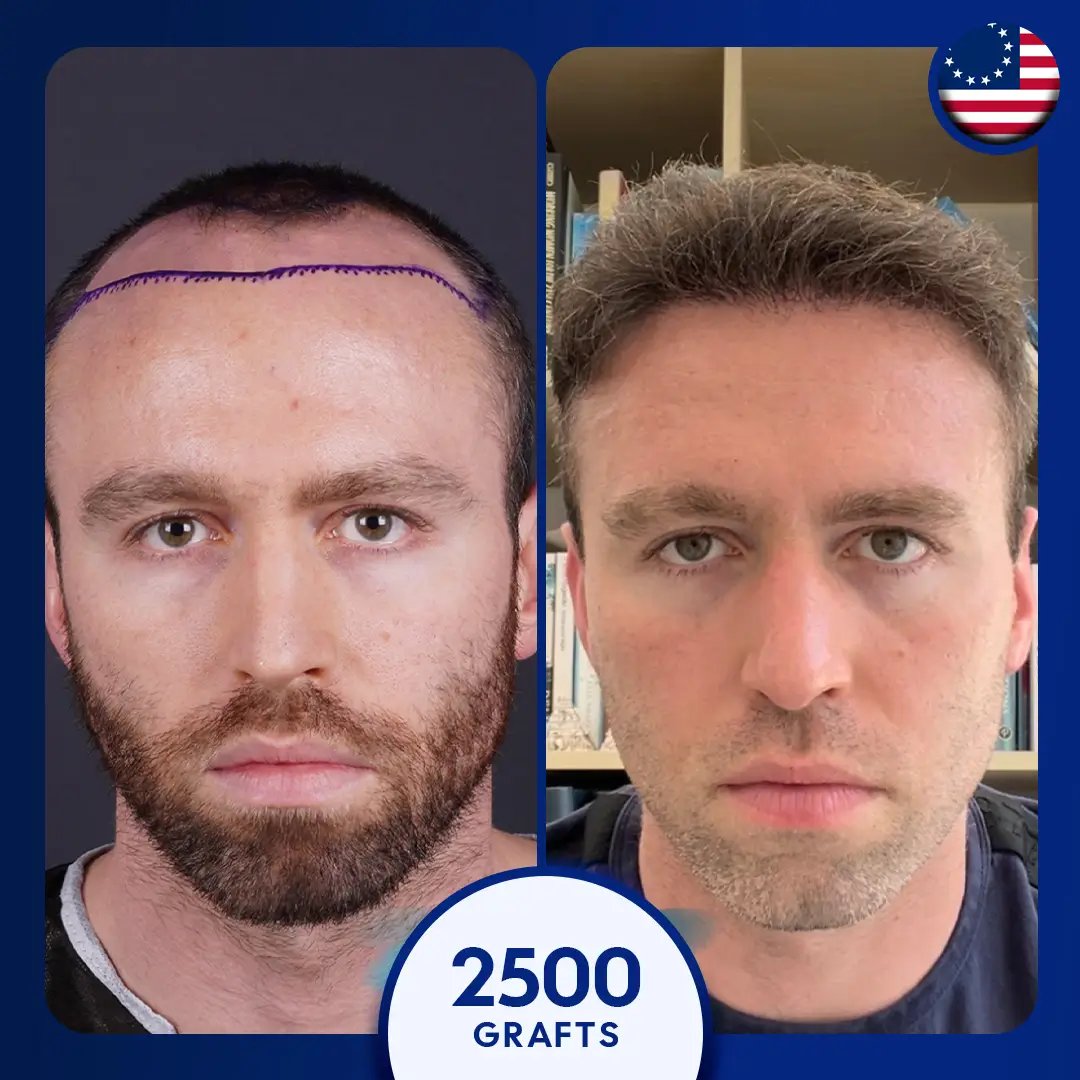 Sapphire fue hair transplant for 2500 grafts for male