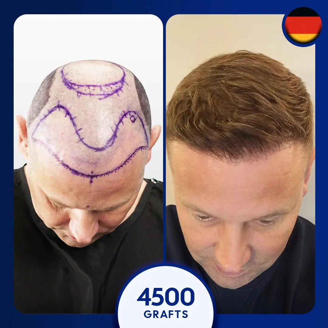 Sapphire fue hair transplant for 4500 grafts for male