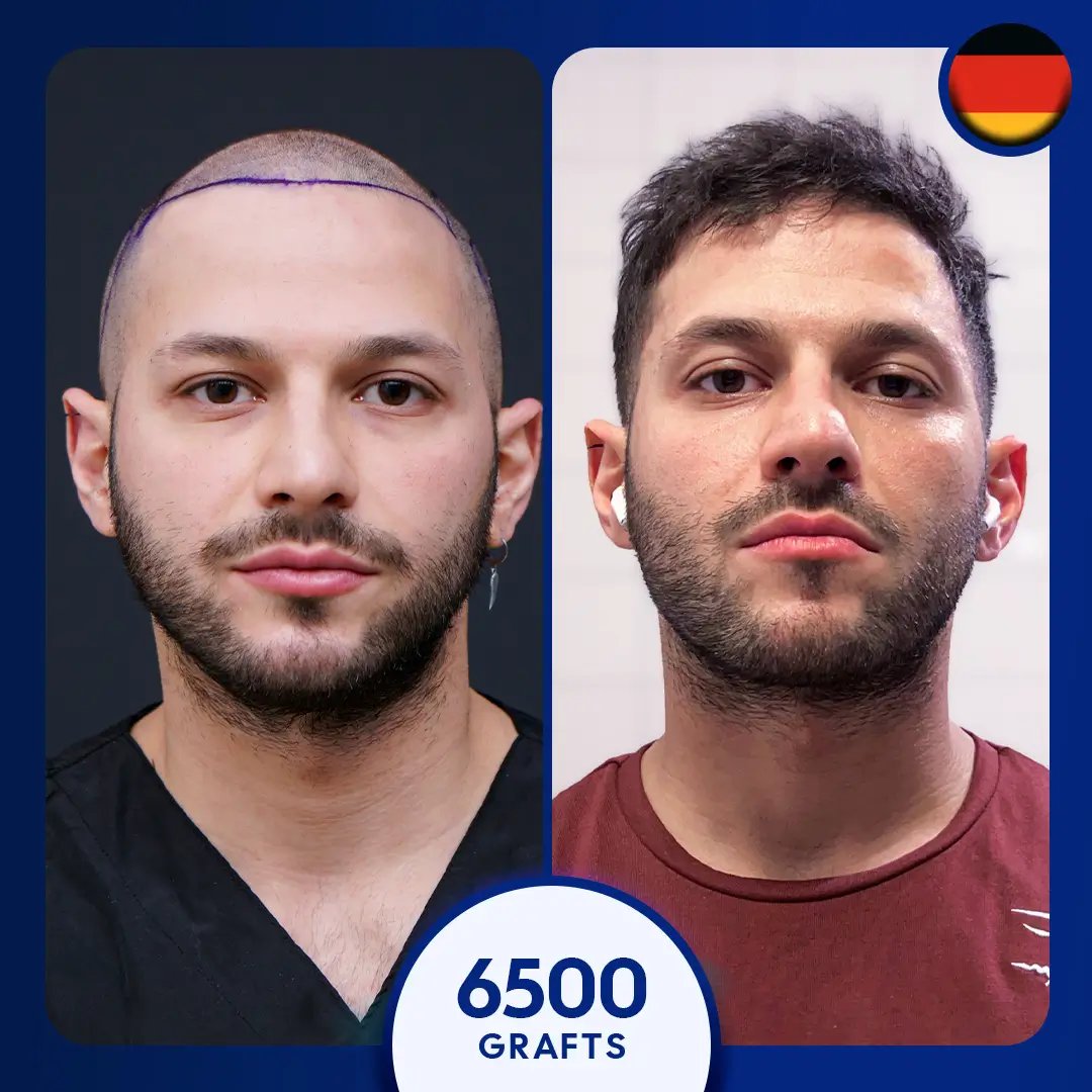 Sapphire fue hair transplant for 6500 grafts for male, full coverage