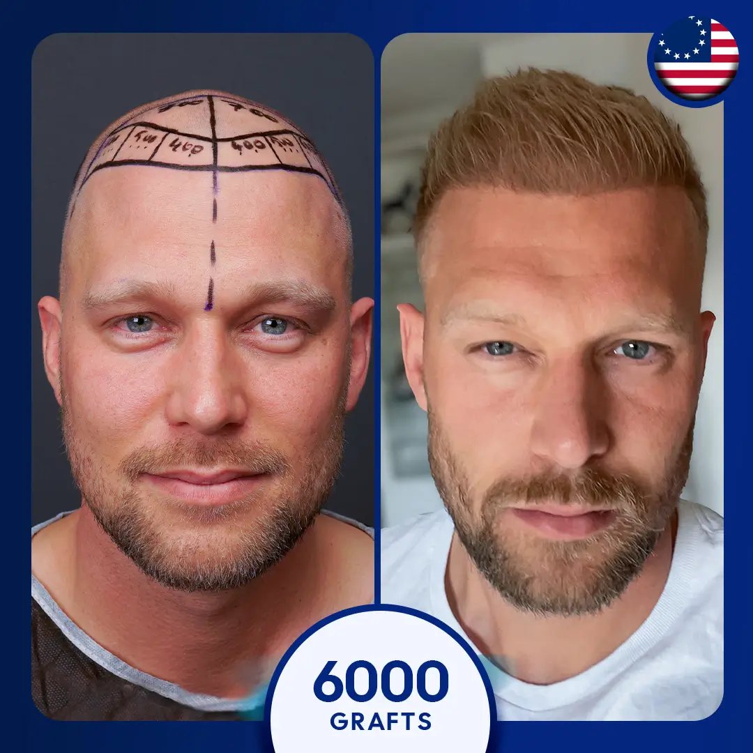 Sapphire fue hair transplant for 6000 grafts for male full coverage, blonde hair