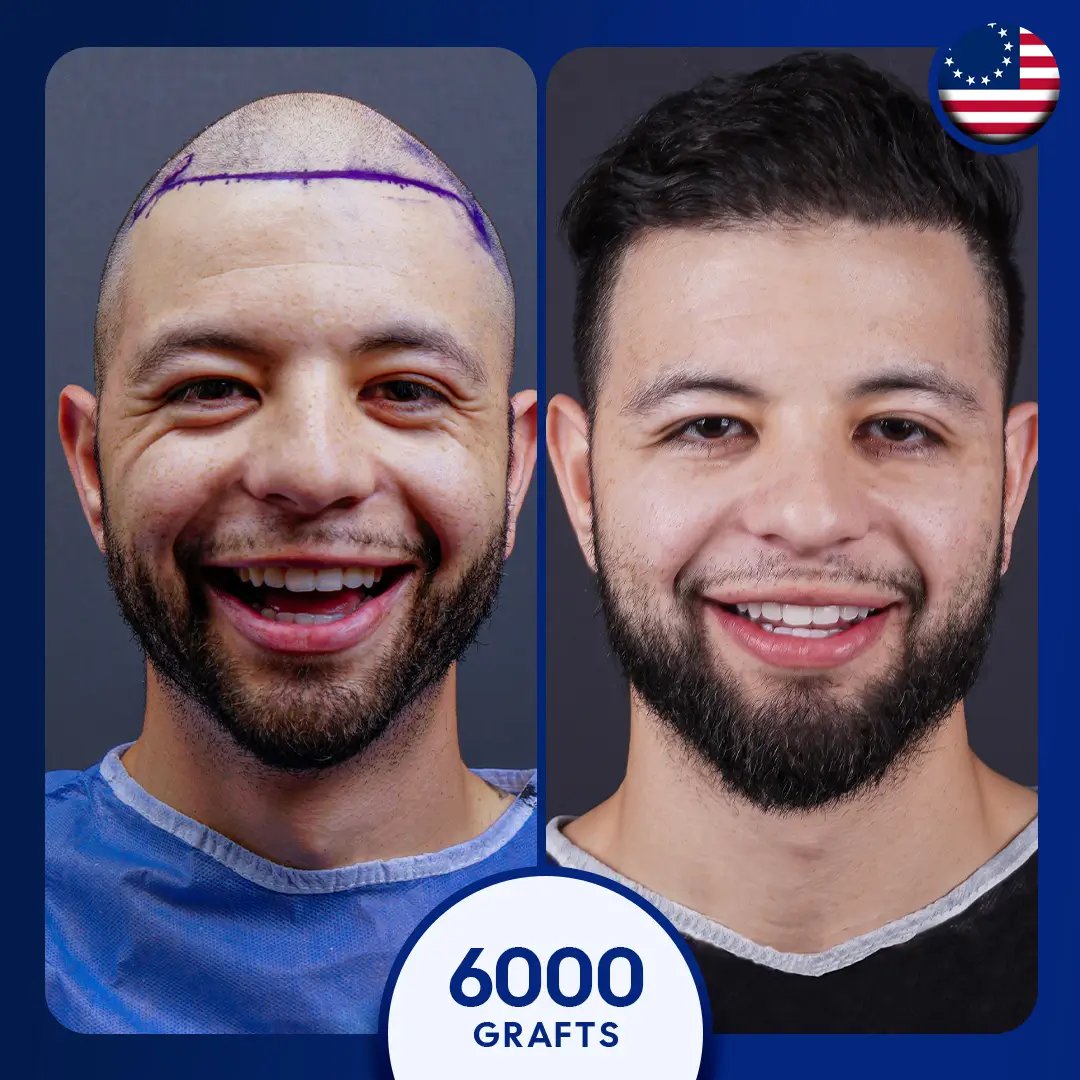 Sapphire fue hair transplant for 6000 grafts for male