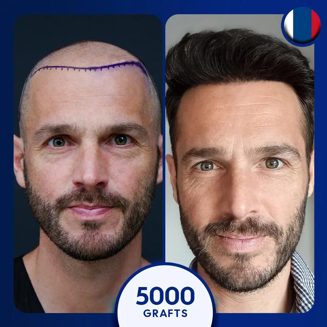 Sapphire fue hair transplant for 5000 grafts for male full coverage