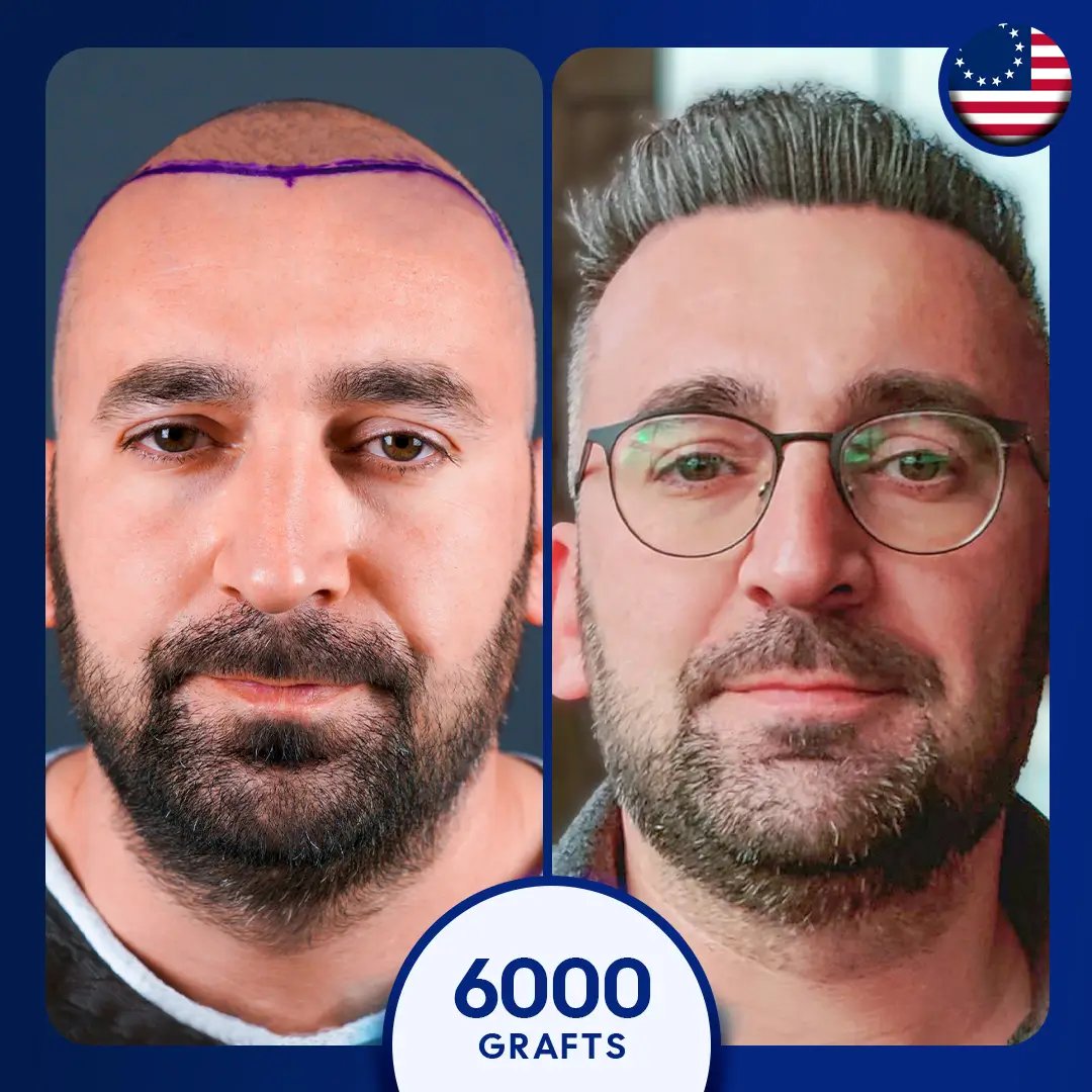 Sapphire fue hair transplant for 6000 grafts for male gray hair