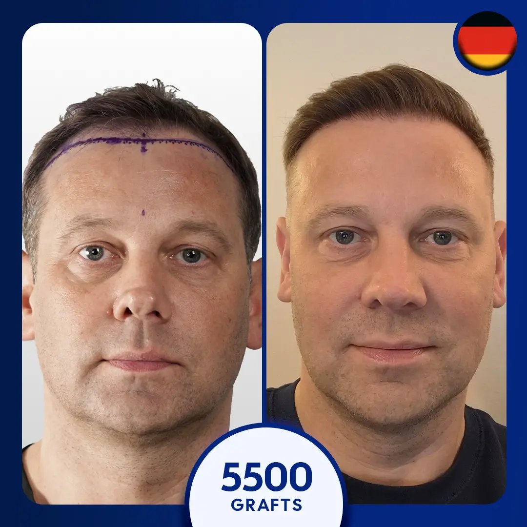 Sapphire fue hair transplant for 5500 grafts for male crown