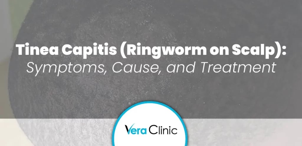 Tinea Capitis (Ringworm on Scalp)