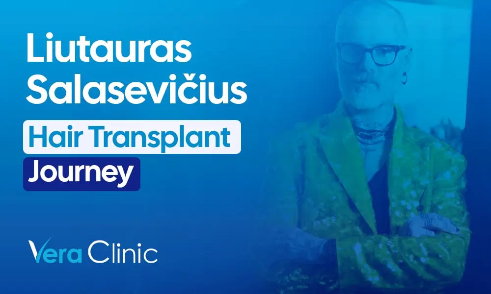 Liutauras Salasevičius celebrity hair transplant before and after