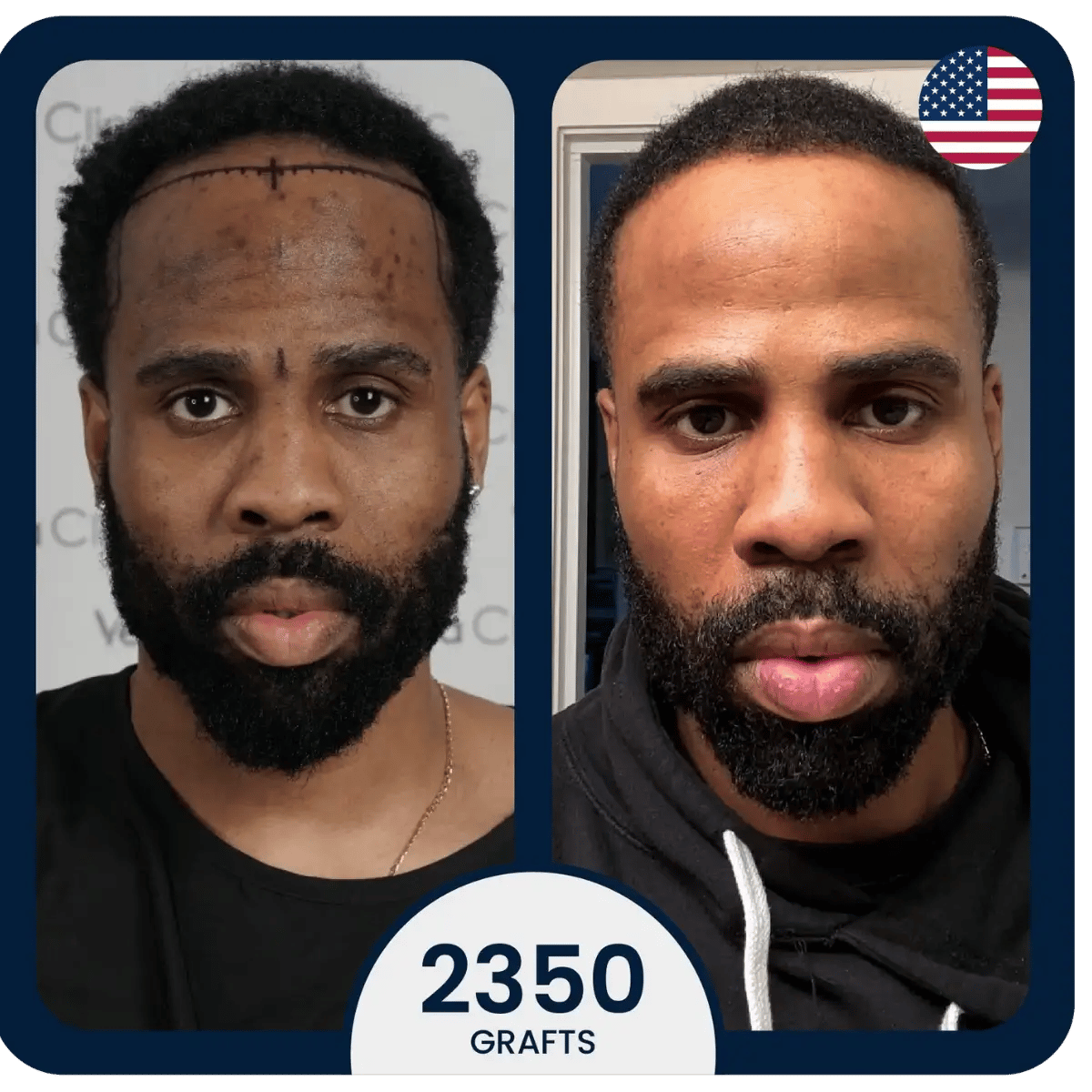 Greffe de cheveux noirs avant et après à la clinique Vera