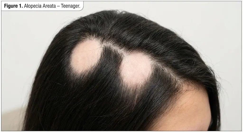 Alopecia Areata