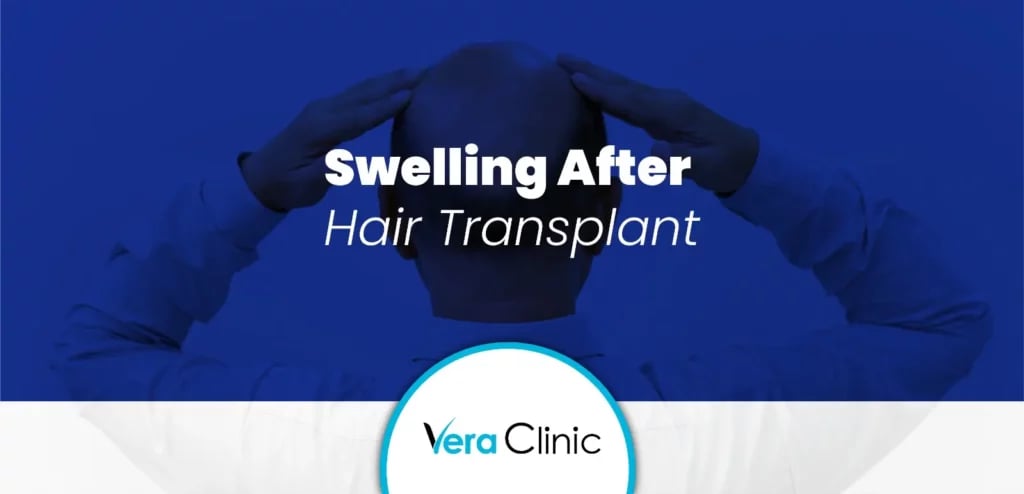 Swelling After Hair Transplant