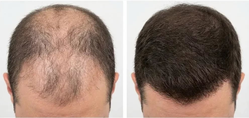 Imagem médica ultra-realista do antes e depois, mostrando a queda de cabelo associada ao Ozempic Imagem médica ultra-realista do antes e depois que mostra a queda de cabelo associada ao Ozempic