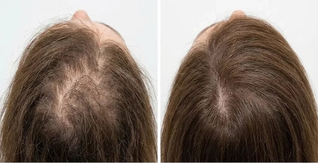 Ультрареалистичные медицинские фотографии «до и после», демонстрирующие выпадение волос после COVID-19. Ультрареалистичные медицинские фотографии «до и после», демонстрирующие выпадение волос после COVID-19.
