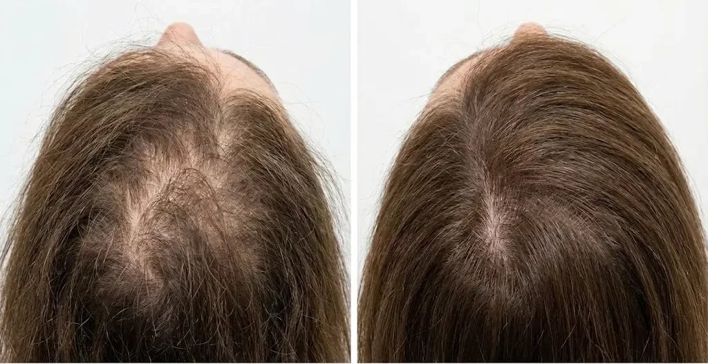 What Does Hair Look Like Before and After Having Malnutrition Hair Loss Ultra-realistic clinical before-and-after image showing malnutrition-related hair loss