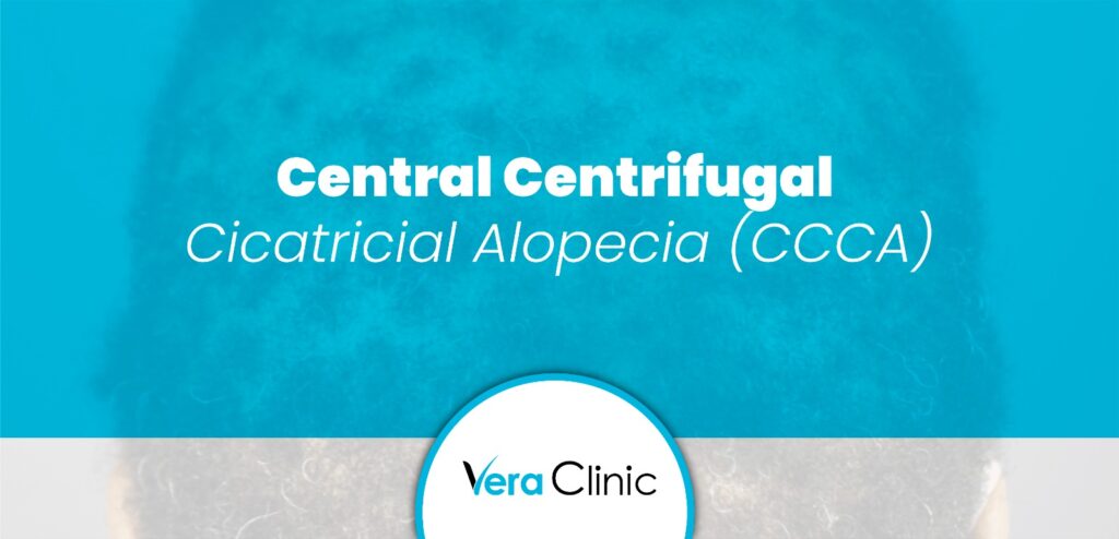 Central Centrifugal Cicatricial Alopecia