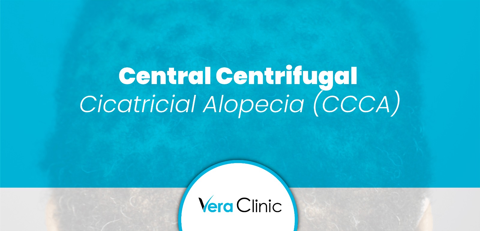 Central Centrifugal Cicatricial Alopecia (CCCA) - Vera Clinic