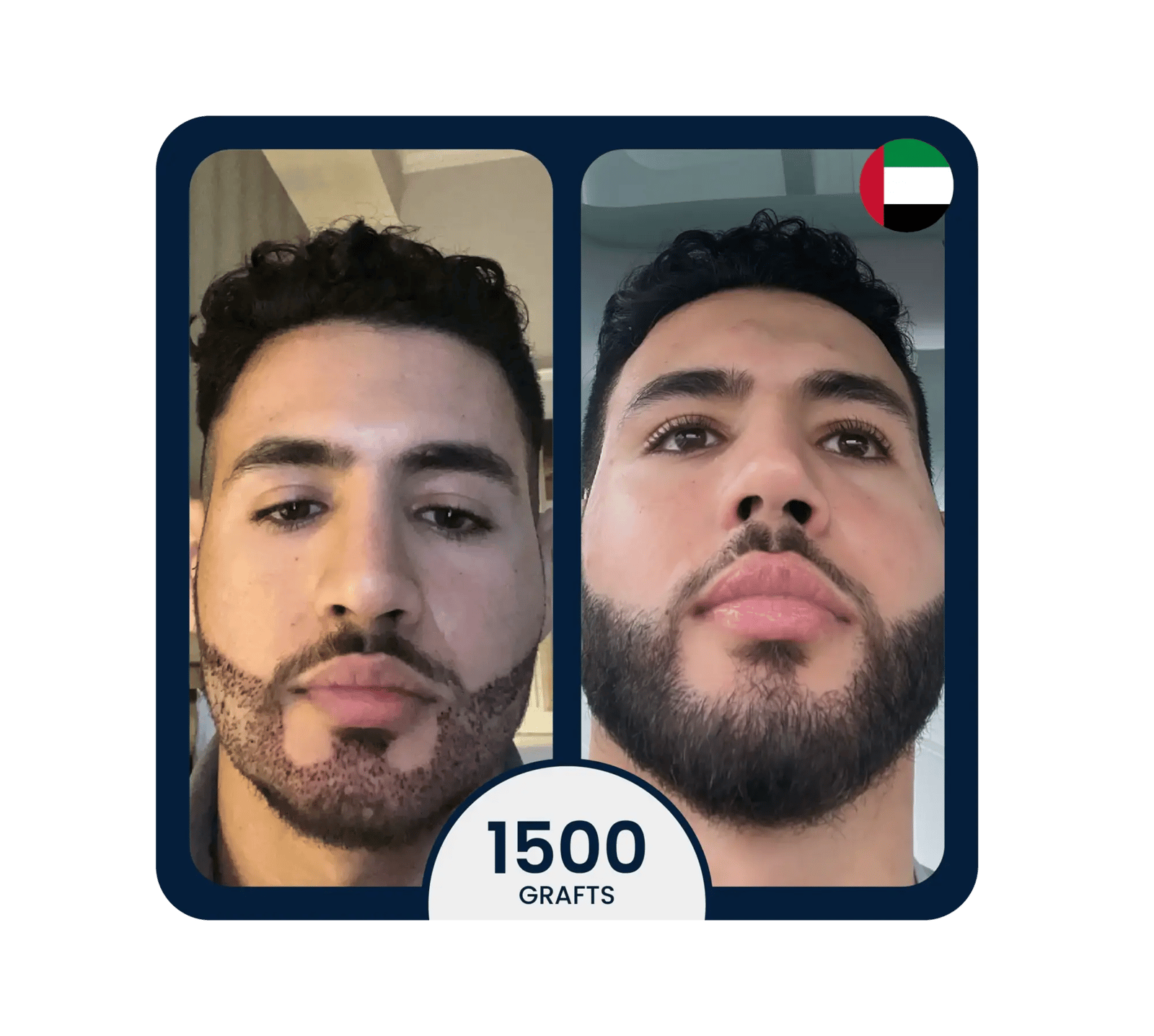 After beard transplant showing full and even facial hair coverage (front view).