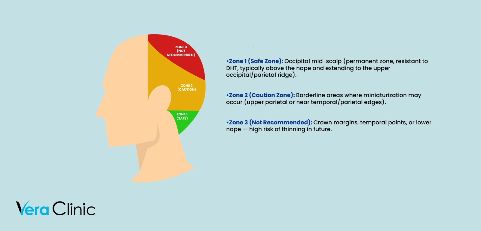 Infográfico da área doadora para transplante capilar Zonas da cabeça Infográfico da área doadora para transplante capilar Zonas da cabeça