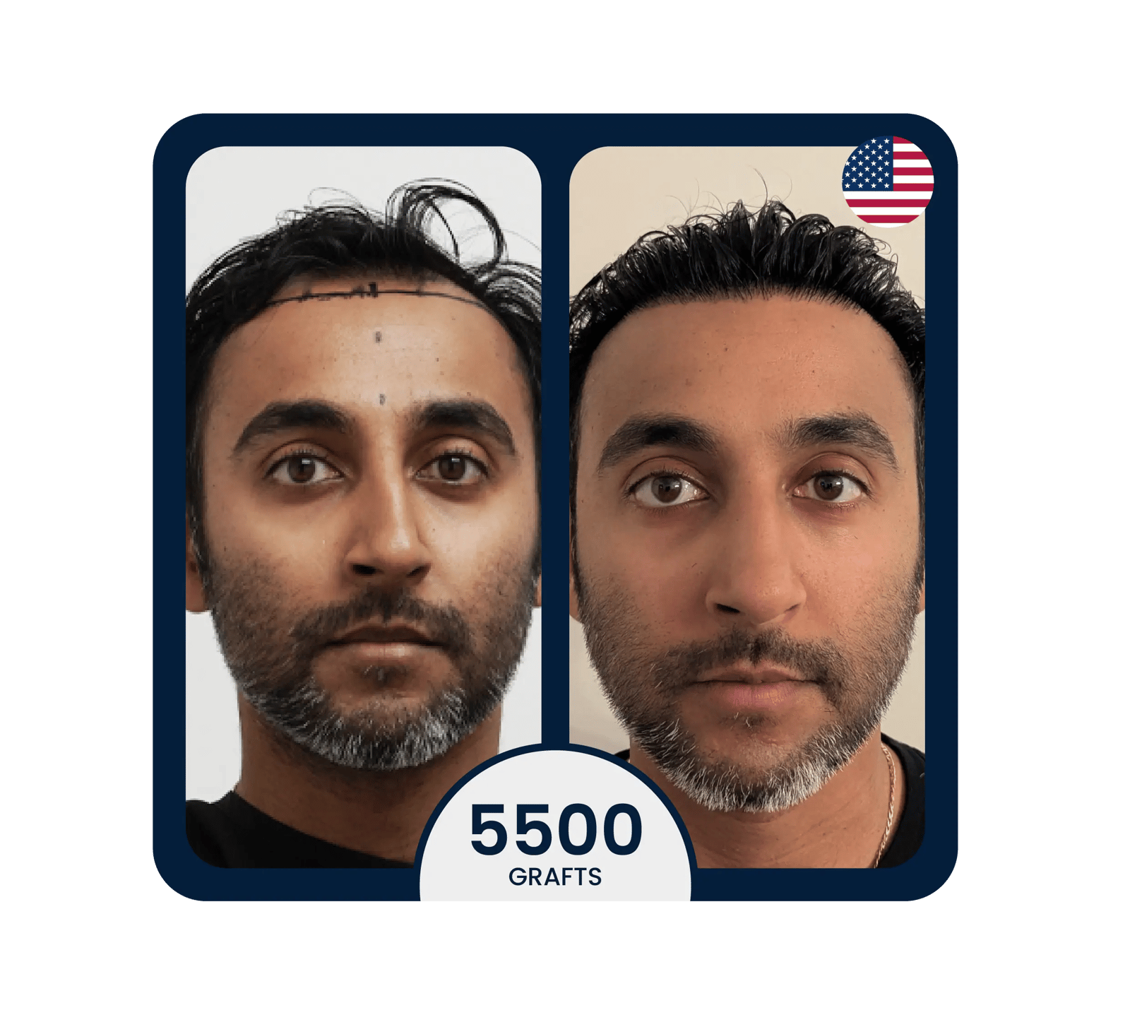 DHI hair transplant before after 6100 grafts
