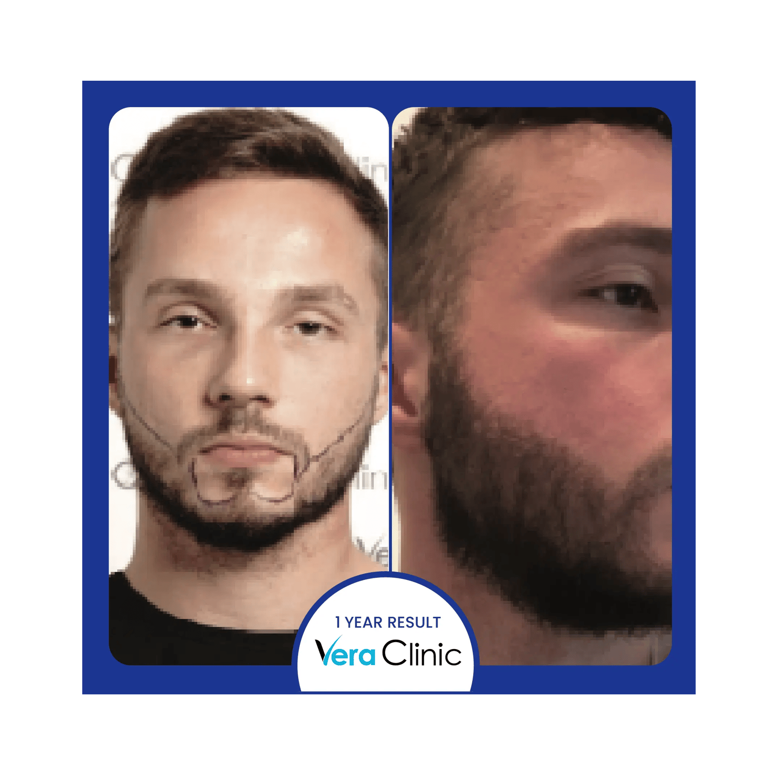 Beard surgery before and after set thin jawline density before FUE in Turkey