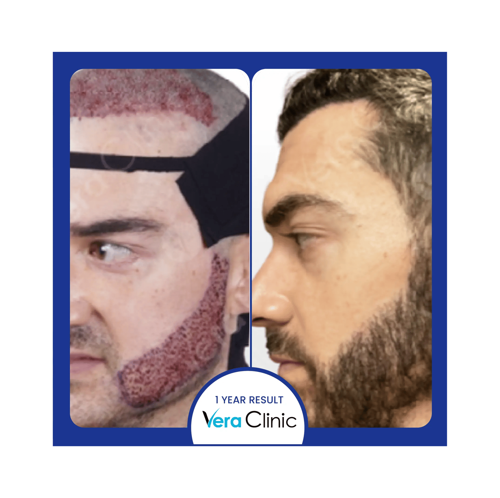 Beard transplant before photo showing patchy cheeks and uneven Turkish beard growth