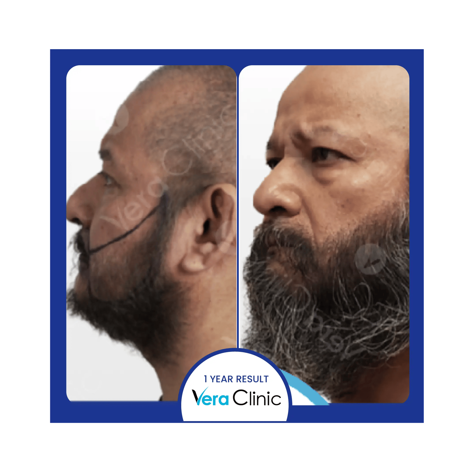 Full beard transplant before photo with visible gaps in mustache and chin