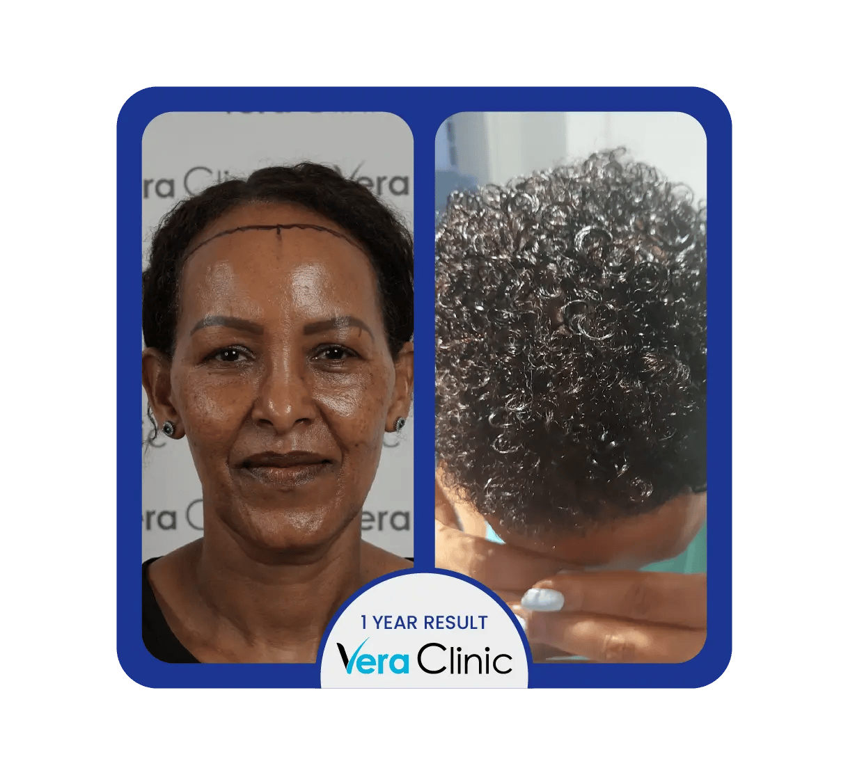antes e depois do transplante capilar feminino