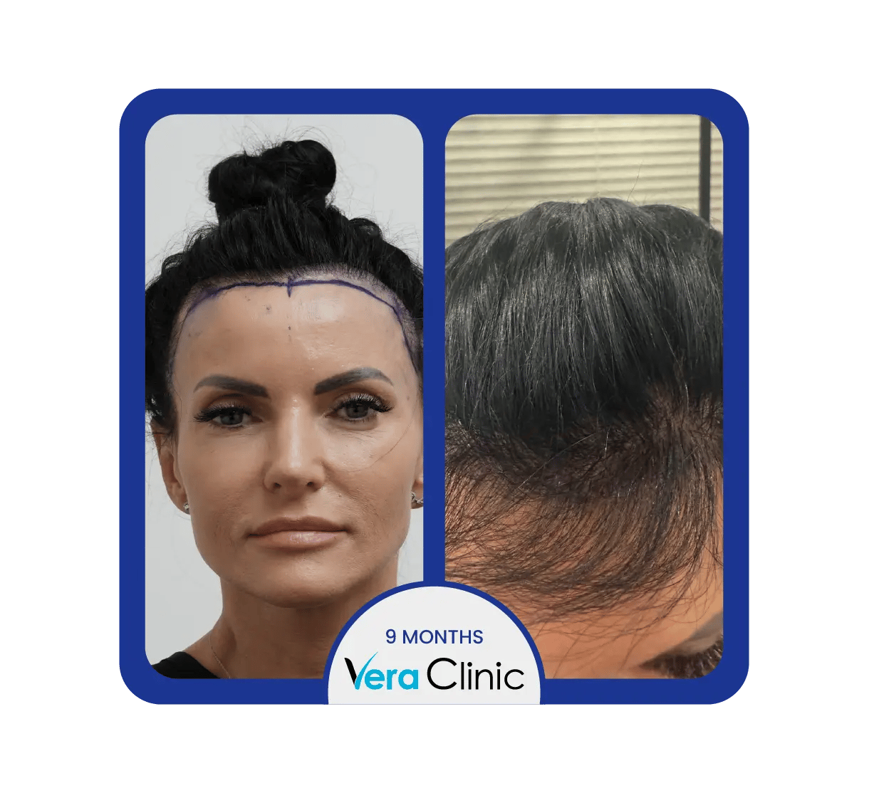 transplante capilar feminino antes e depois