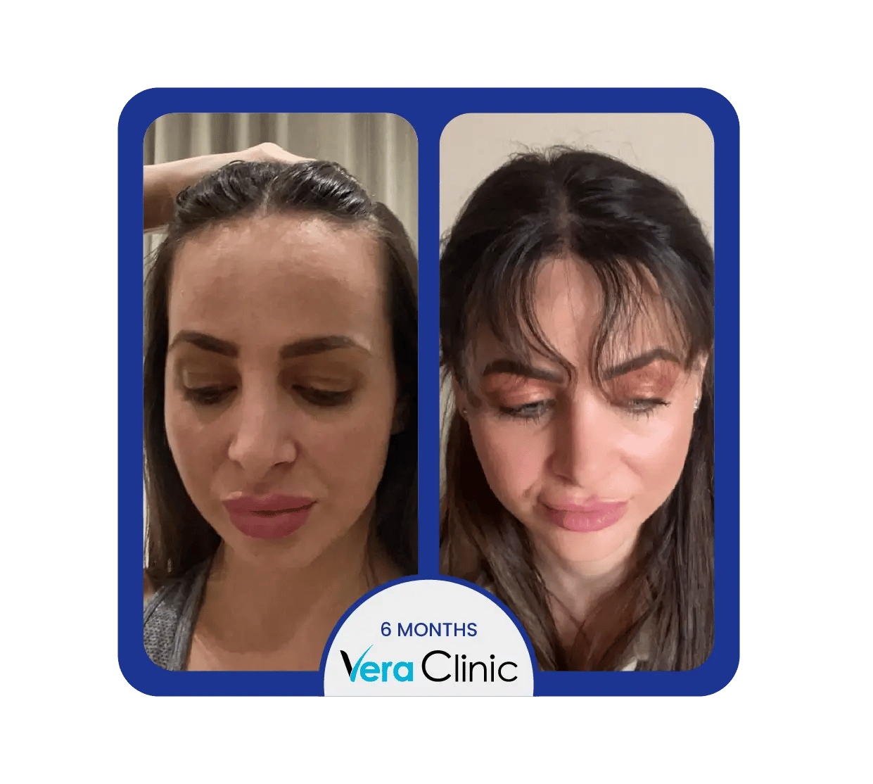 Comparação antes e depois do transplante capilar feminino em Istambul, na Clínica Vera. Destaque para o volume capilar mais cheio e melhor cobertura do couro cabeludo.